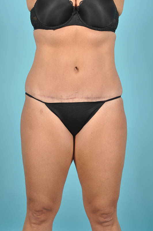 Tummy Tuck Before & After Image Patient 29118