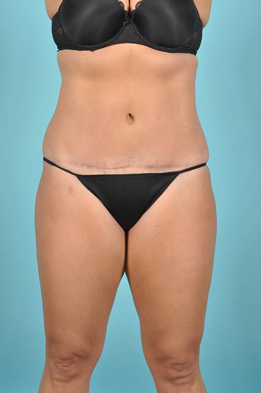 Tummy Tuck Before & After Image