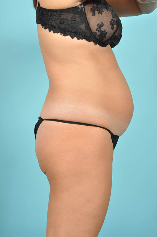 Tummy Tuck Before & After Image