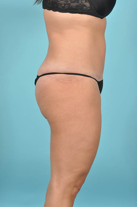 Tummy Tuck Before & After Image Patient 29118