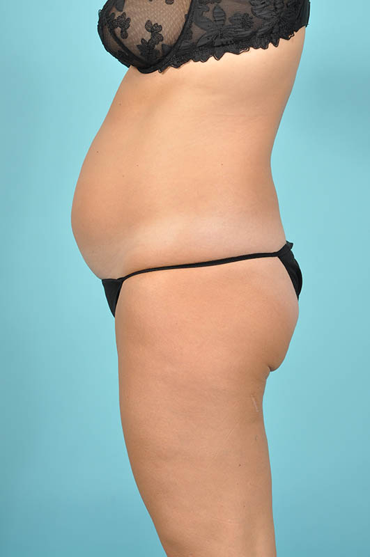 Tummy Tuck Before & After Image Patient 29118