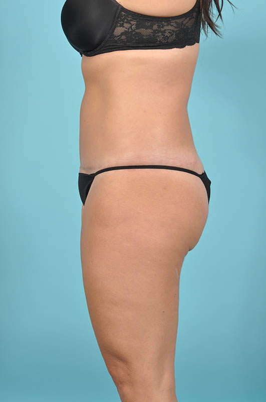 Tummy Tuck Before & After Image Patient 29118