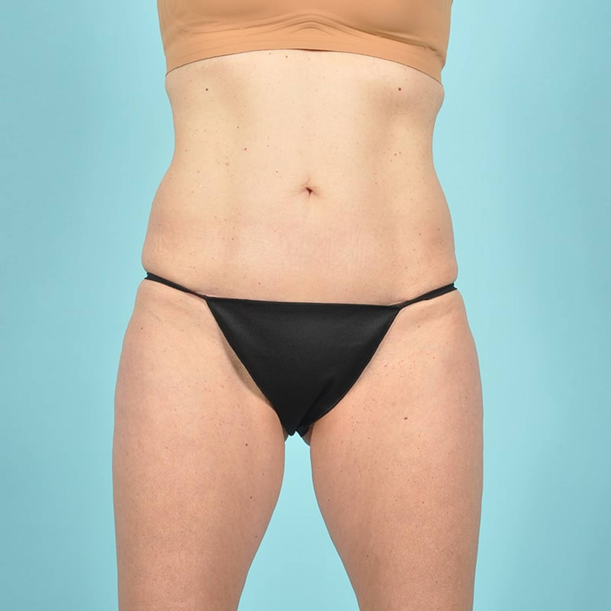 Tummy Tuck Before & After Image