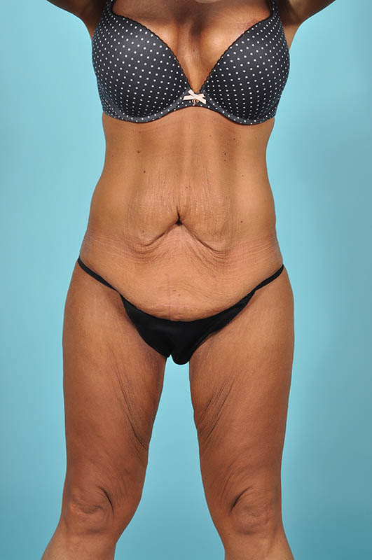 Tummy Tuck Before & After Image Patient 29128