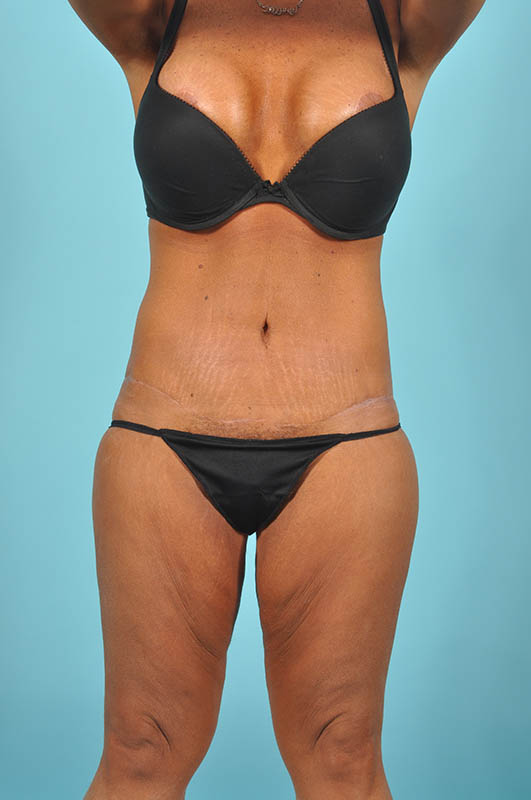 Tummy Tuck Before & After Image