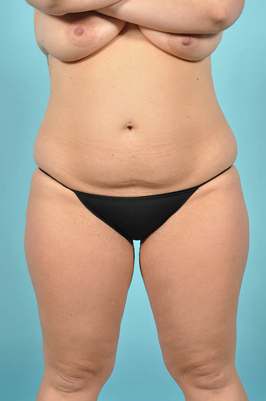 Tummy Tuck Before & After Image Patient 29139