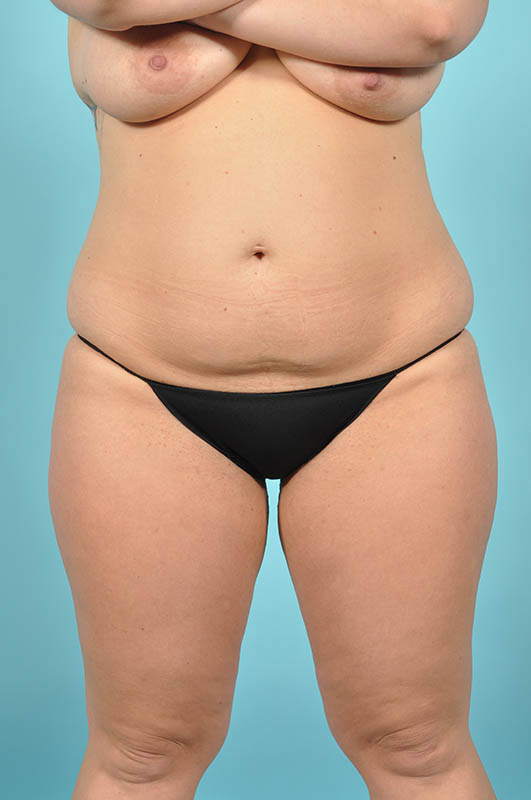 Tummy Tuck Before & After Image