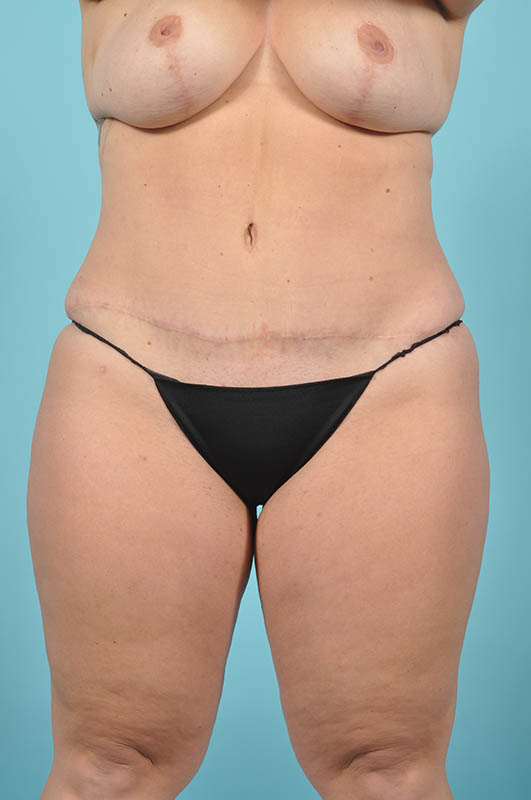 Tummy Tuck Before & After Image