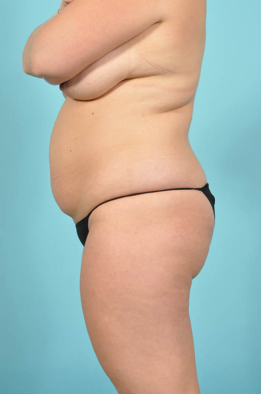 Tummy Tuck Before & After Image Patient 29139