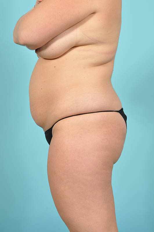 Tummy Tuck Before & After Image