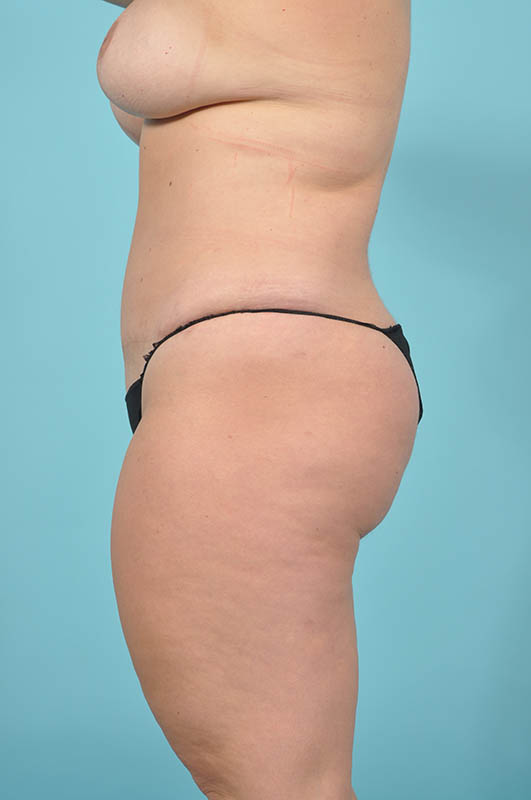 Tummy Tuck Before & After Image