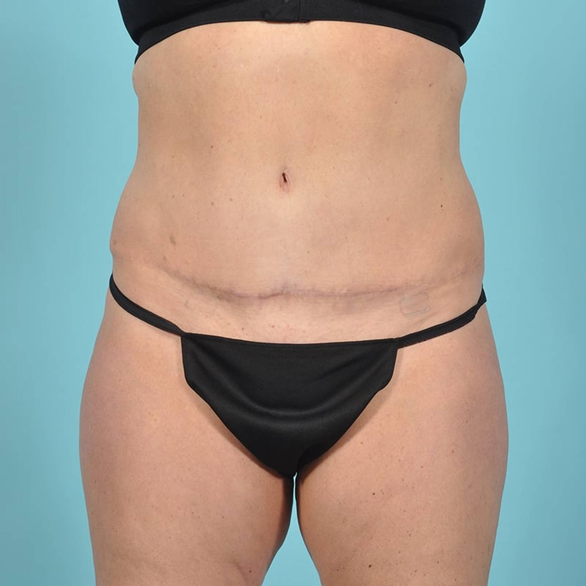 Tummy Tuck Before & After Image