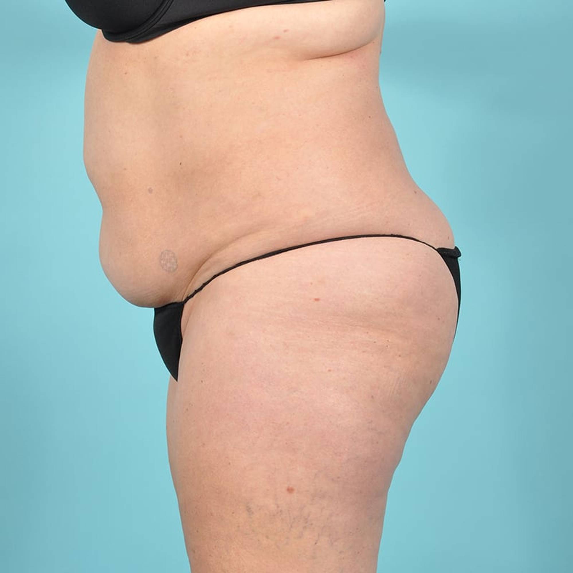 Tummy Tuck Before & After Image