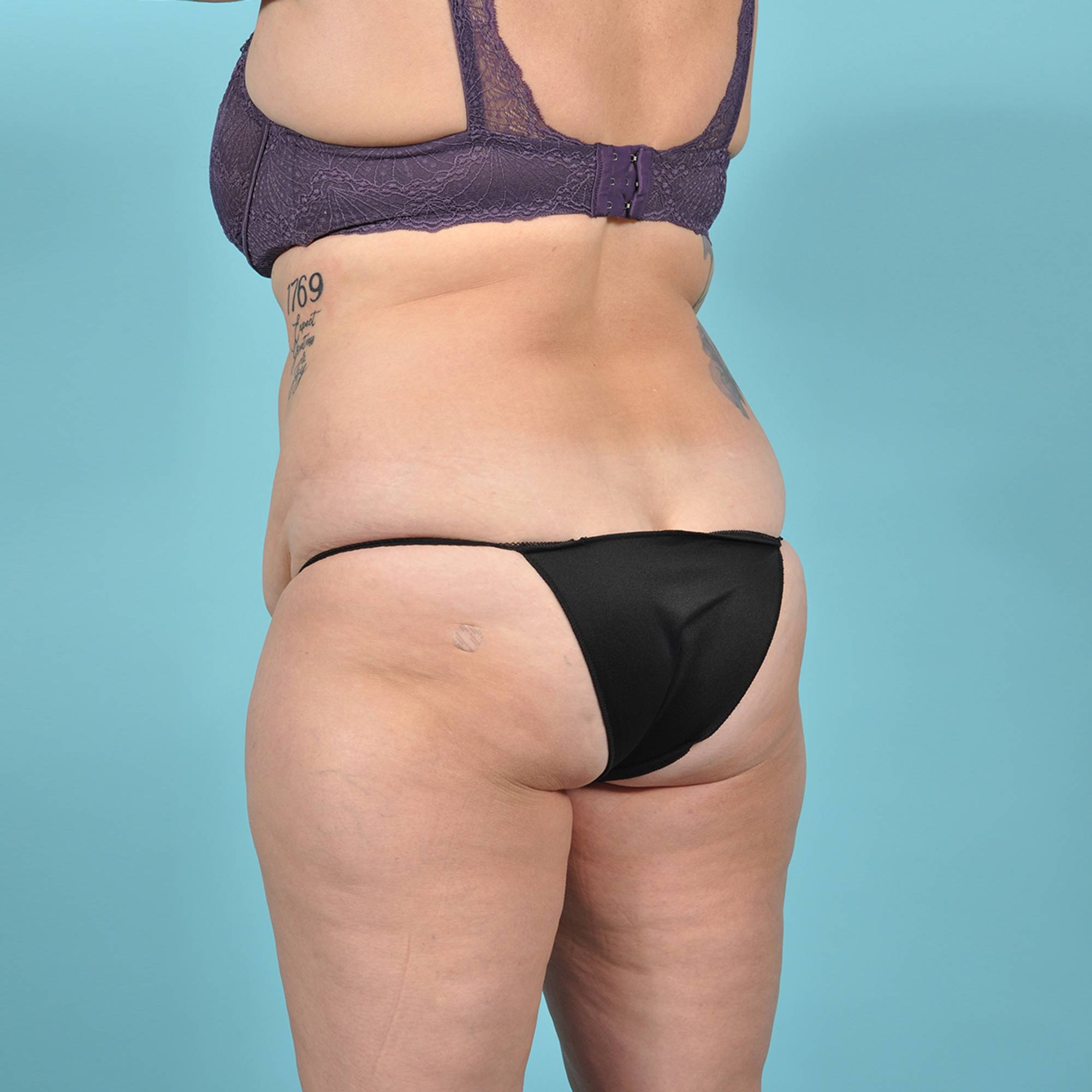Tummy Tuck Before & After Image