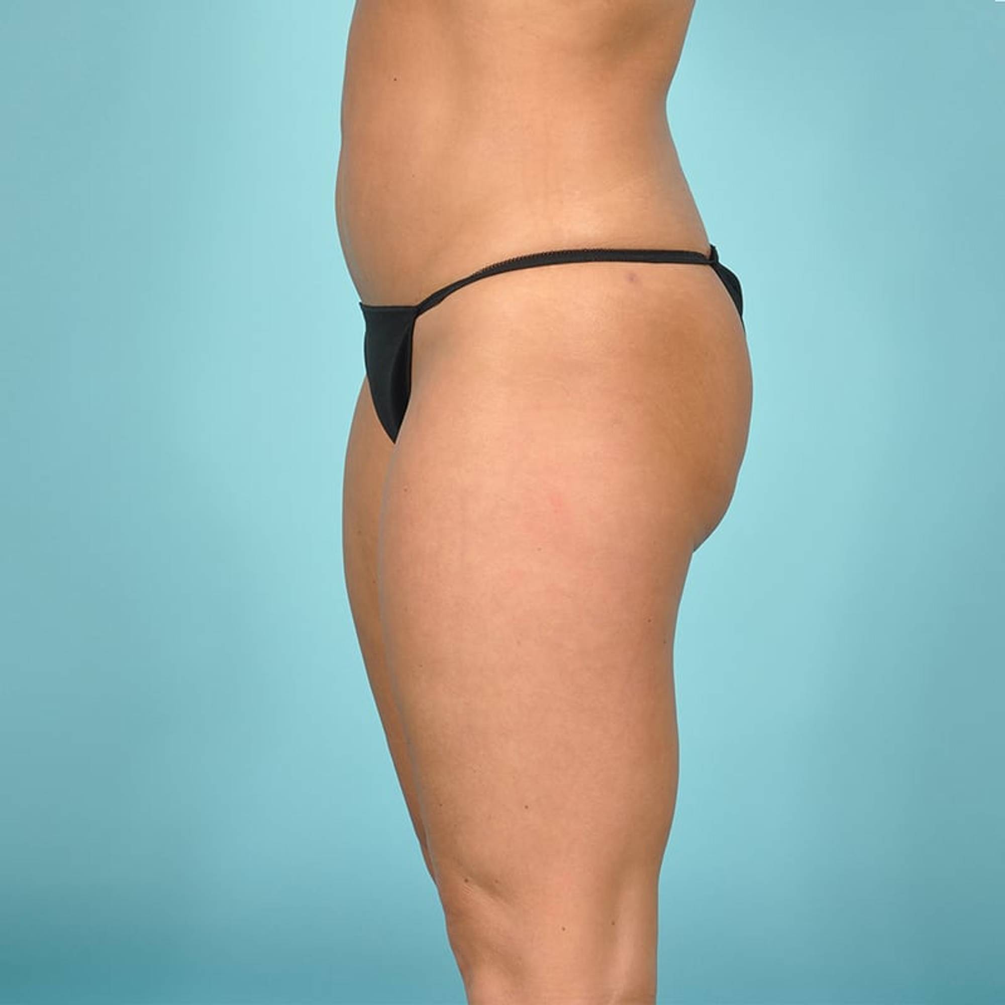 Tummy Tuck Before & After Image