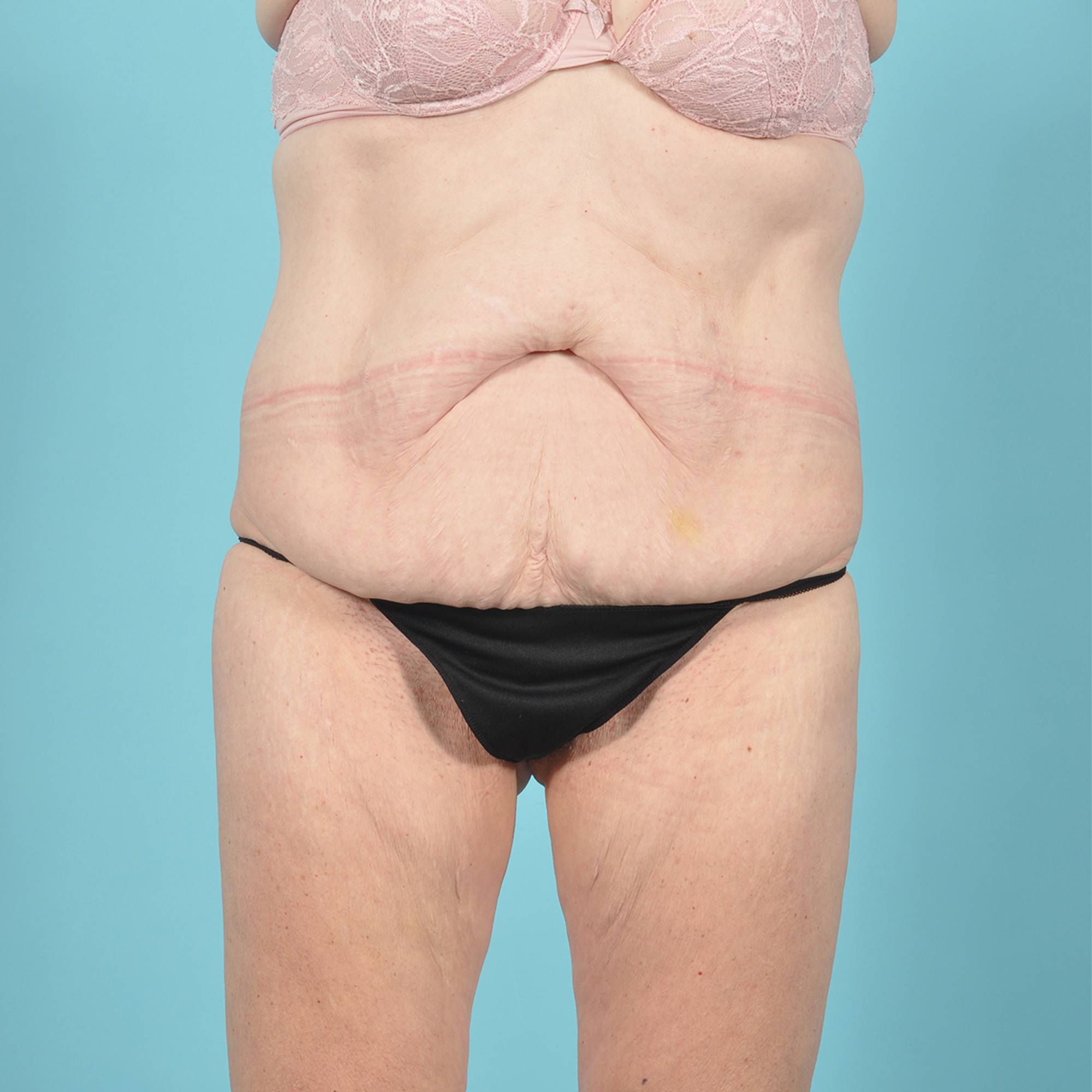 Tummy Tuck Before & After Image
