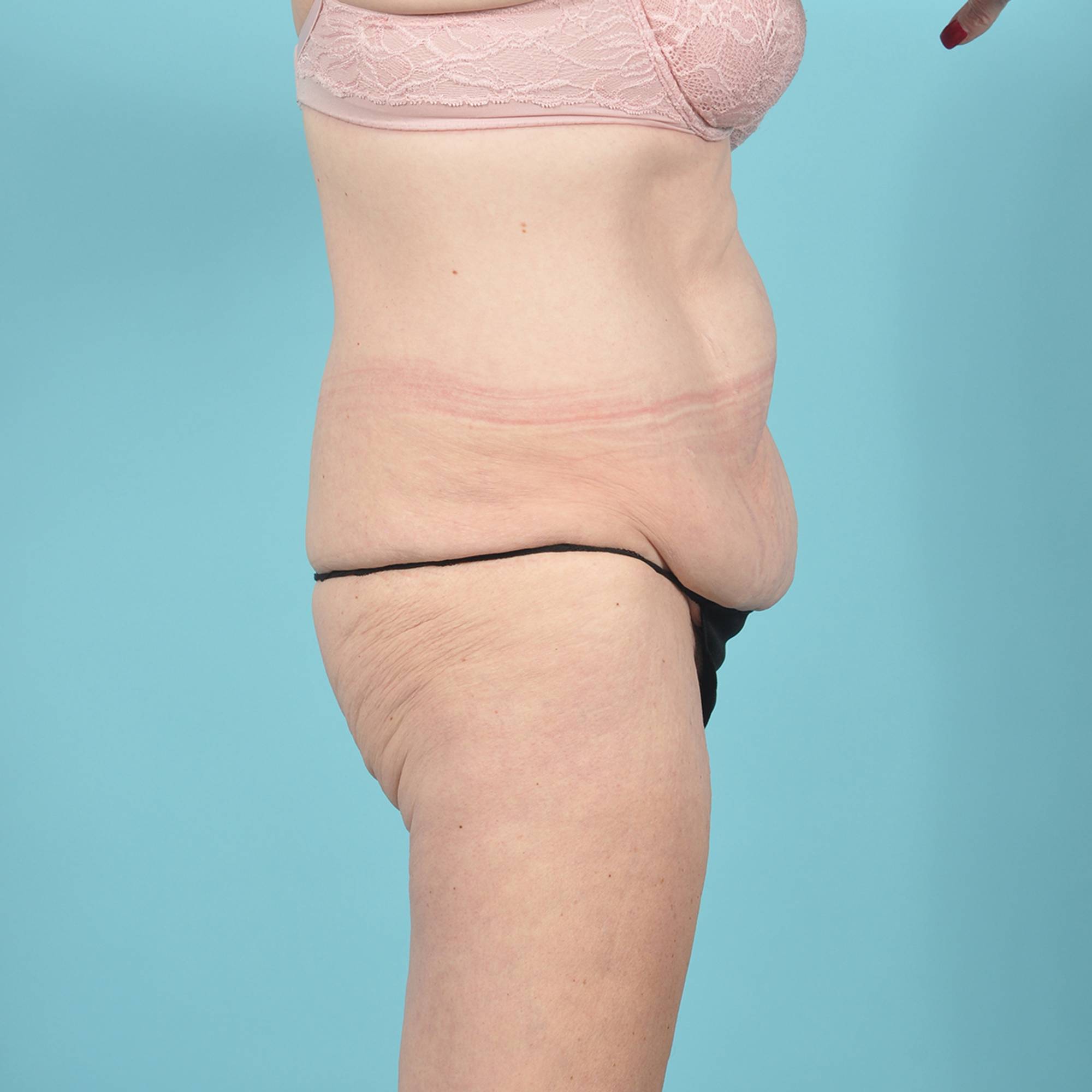 Tummy Tuck Before & After Image