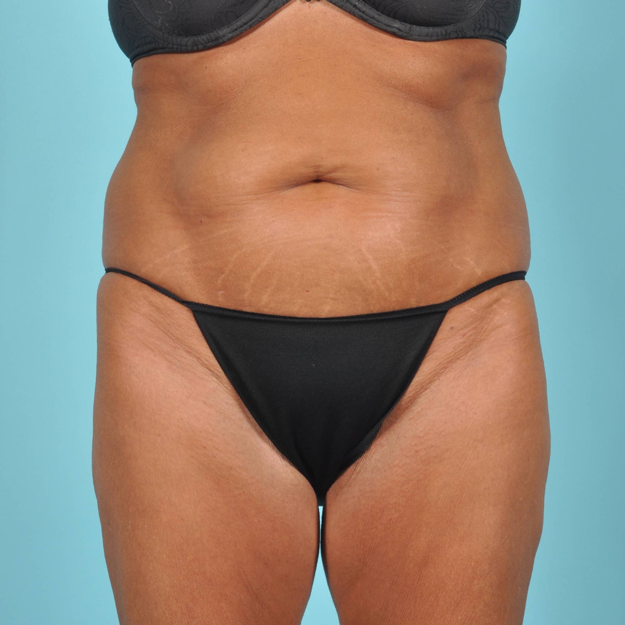 Tummy Tuck Before & After Image