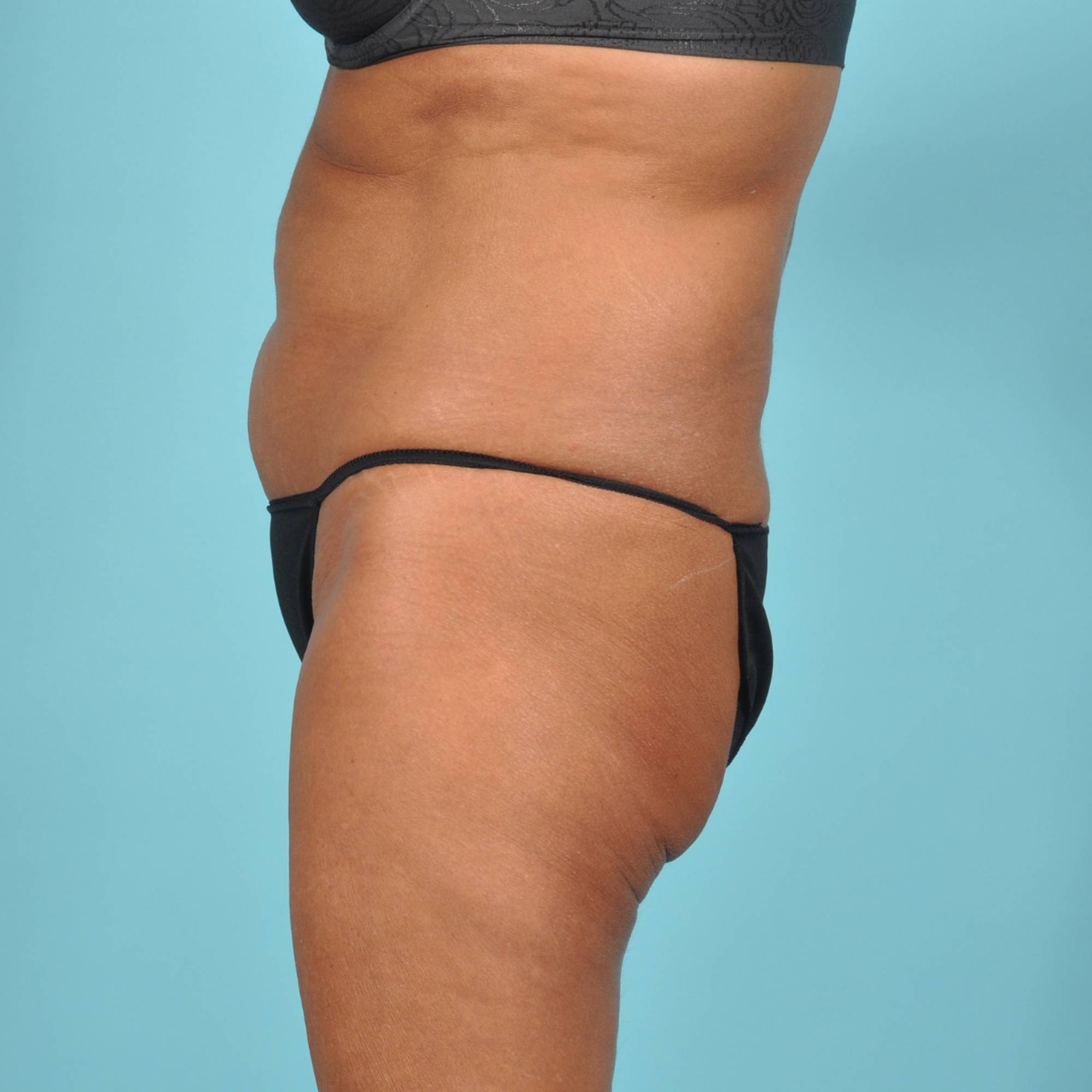 Tummy Tuck Before & After Image