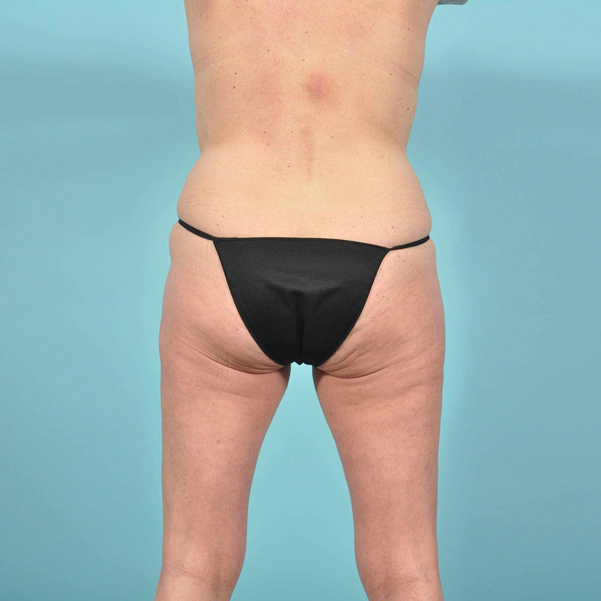 Tummy Tuck Before & After Image
