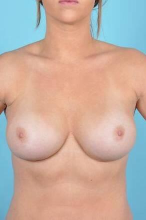 Breast Augmentation Before & After Image Patient 28902