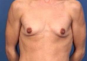 Breast Augmentation Before & After Image