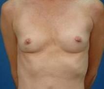 Breast Augmentation Before & After Image Patient 28906