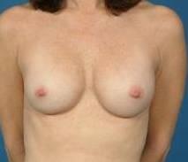 Breast Augmentation Before & After Image