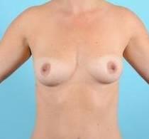 Breast Augmentation Before & After Image Patient 28907