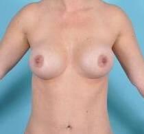 Breast Augmentation Before & After Image