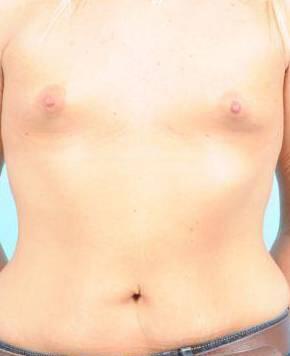 Breast Augmentation Before & After Image