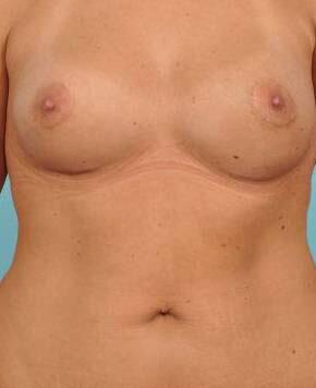 Breast Augmentation Before & After Image Patient 28909