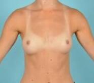 Breast Augmentation Before & After Image