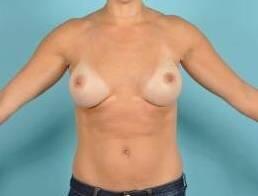 Breast Augmentation Before & After Image