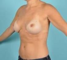 Breast Augmentation Before & After Image