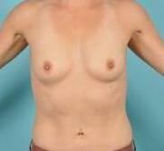 Breast Augmentation Before & After Image Patient 28914