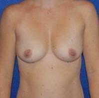 Breast Augmentation Before & After Image