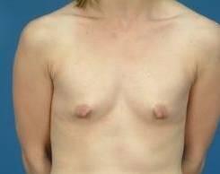 Breast Augmentation Before & After Image Patient 28919