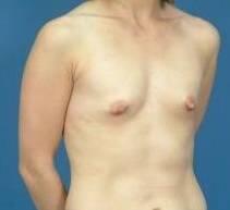 Breast Augmentation Before & After Image