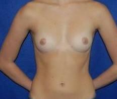 Breast Augmentation Before & After Image Patient 28920