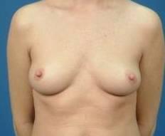 Breast Augmentation Before & After Image