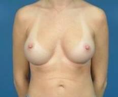 Breast Augmentation Before & After Image