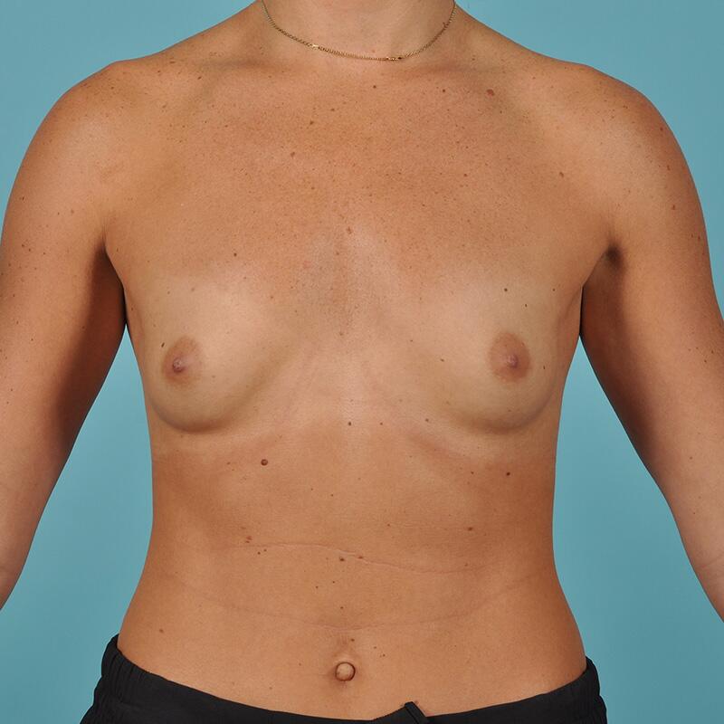 Breast Augmentation Before & After Image Patient 28928
