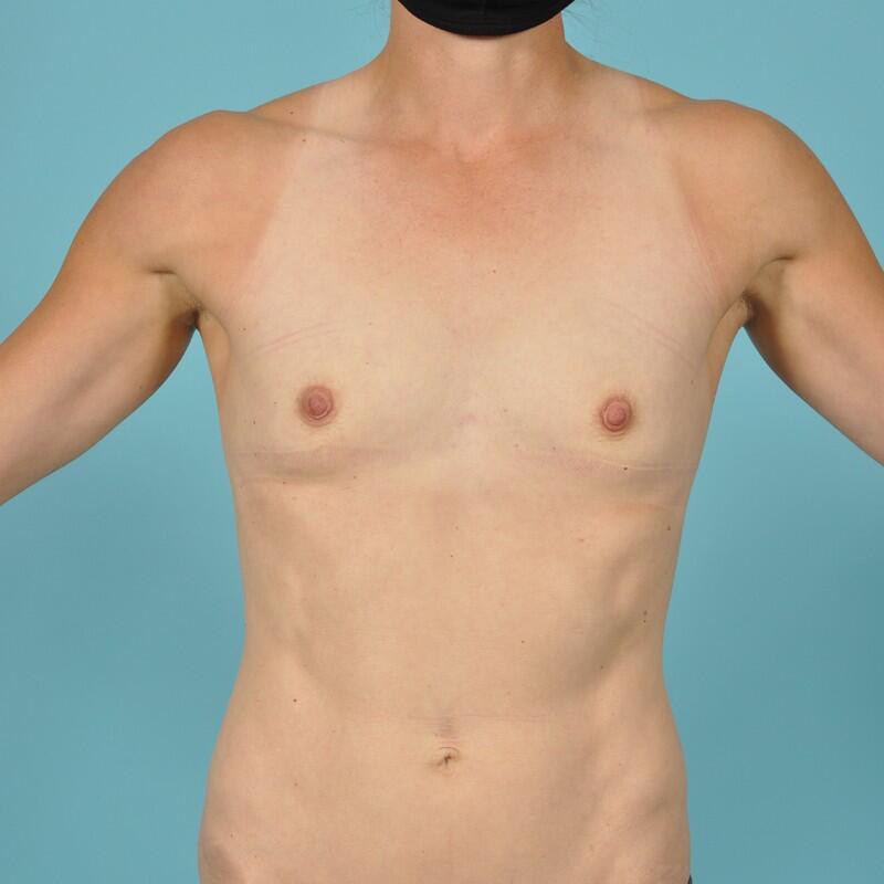 Breast Augmentation Before & After Image Patient 28932