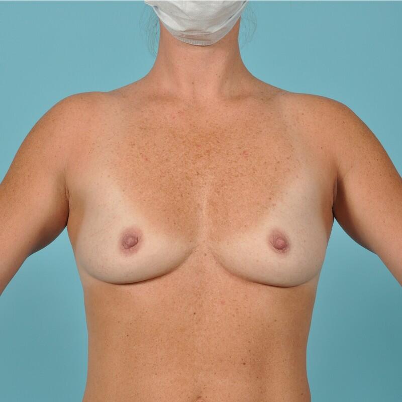 Breast Augmentation Before & After Image Patient 28933
