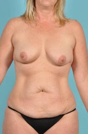 Breast Augmentation Before & After Image