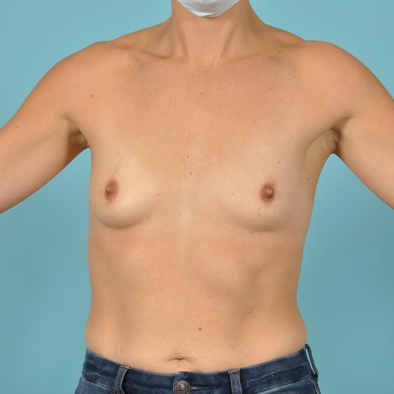 Breast Augmentation Before & After Image Patient 28937