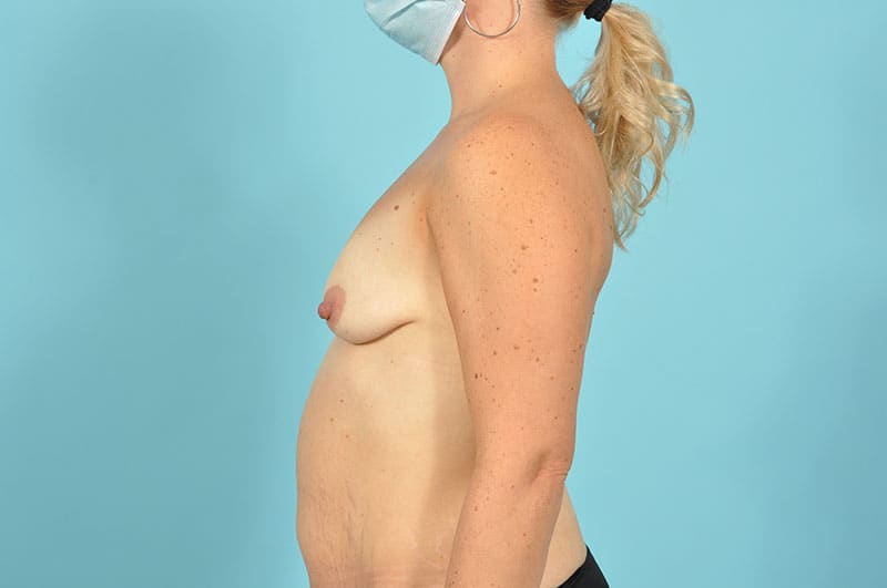 Breast Augmentation Before & After Image Patient 29146