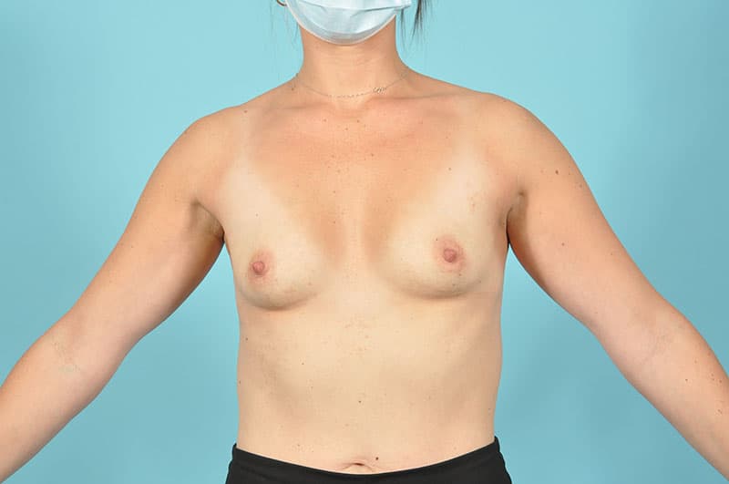 Breast Augmentation Before & After Image