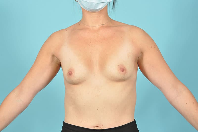 Breast Augmentation Before & After Image Patient 29643